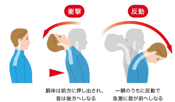 交通事故の衝撃で首が前後しなる「むち打ち（頚椎捻挫）」の発生メカニズム図解