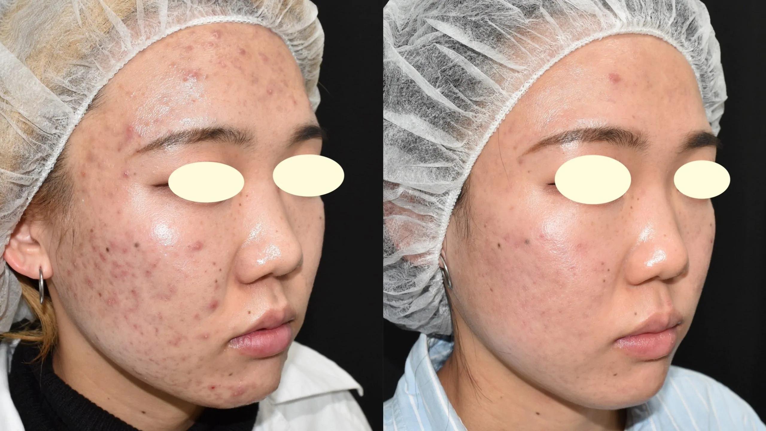 皮膚科でのニキビ治療による重度な肌荒れ・赤みの劇的な改善を示すビフォーアフター症例写真