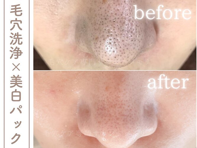 毛穴洗浄と美白パックによる鼻の黒ずみ（いちご鼻）の劇的な改善を示すビフォーアフター比較写真
