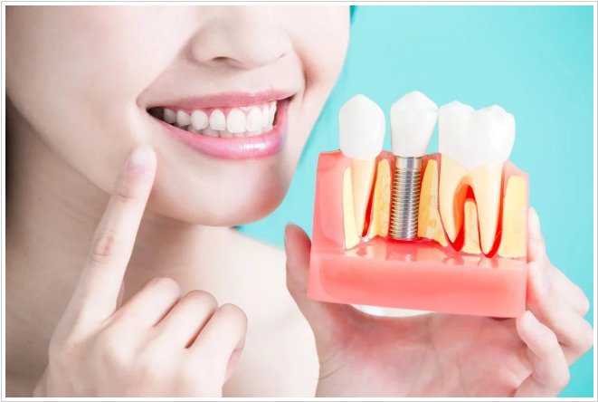 インプラントと歯茎の構造模型を指差しおすすめする女性