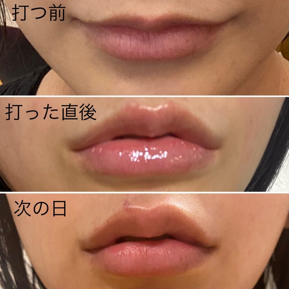 唇ヒアルロン酸注入直後から翌日までのダウンタイム経過と腫れの様子（打つ前・直後・次の日）
