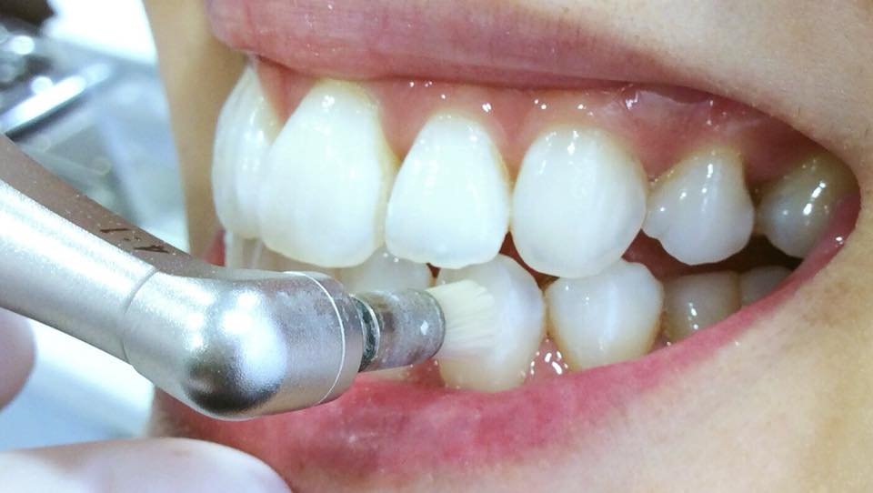 歯科衛生士が専用機器（PMTC）を使って歯の着色汚れや歯石を除去しているクリーニングの様子