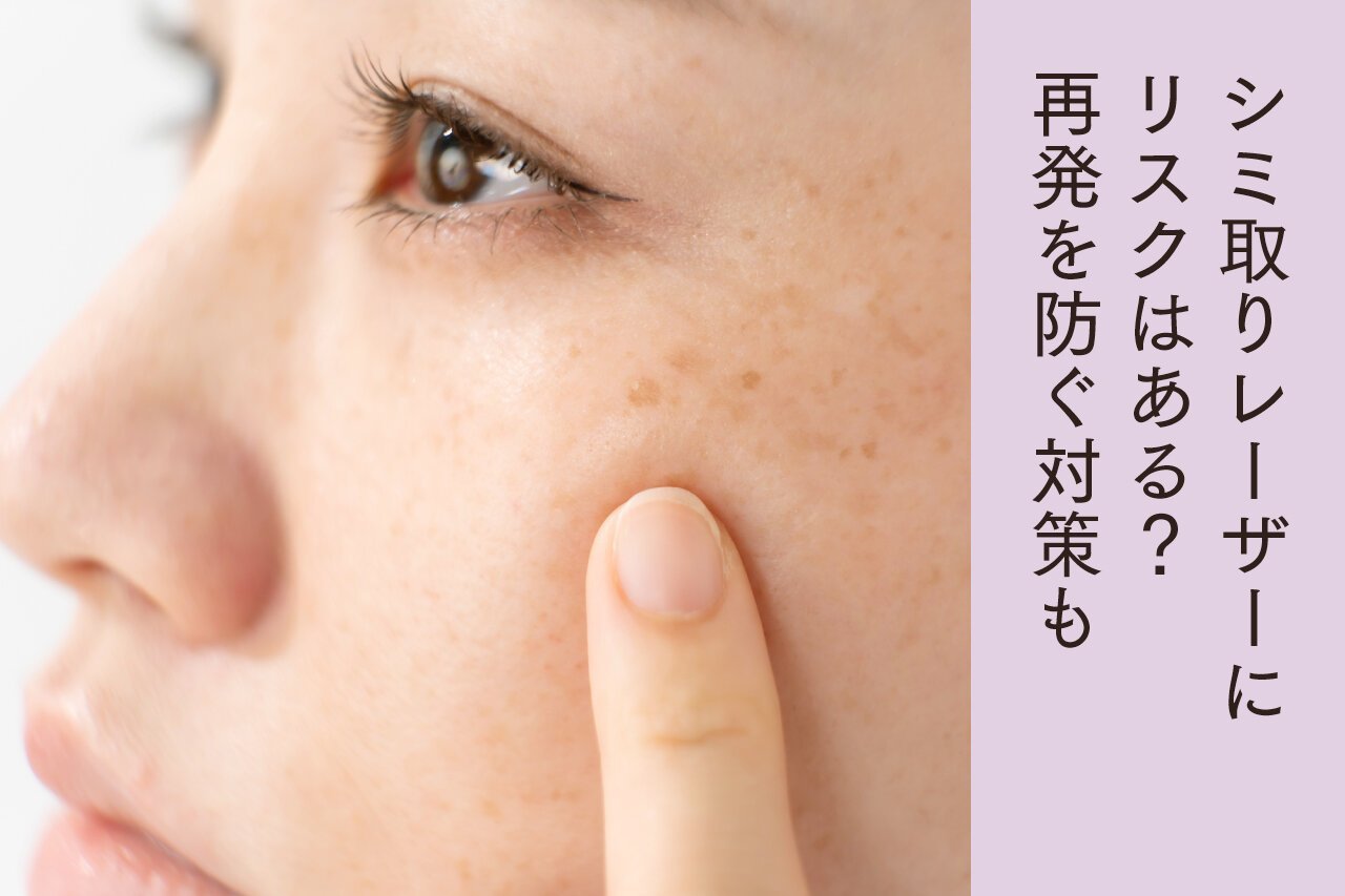 シミ取りレーザーにリスクはある？再発を防ぐ対策も。というテキストが入った、女性が頬のシミを気にしているイメージ画像