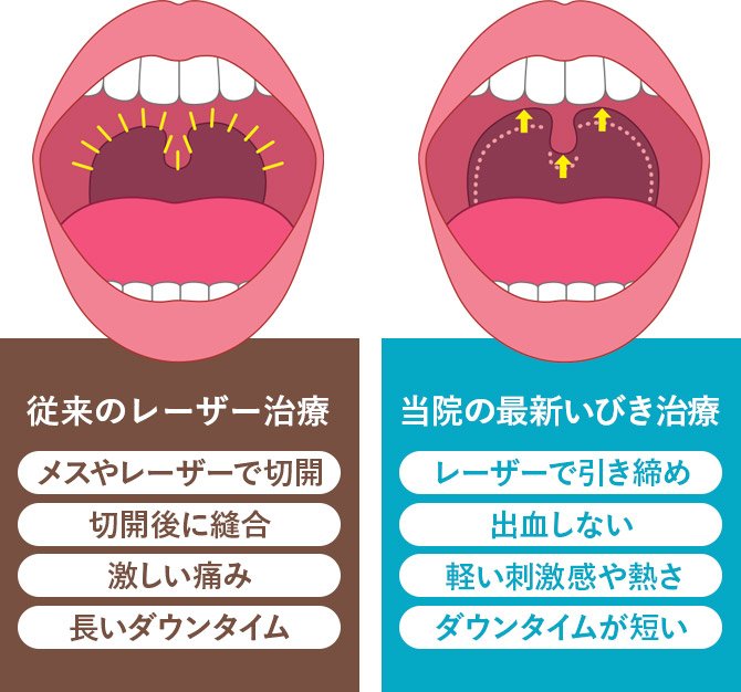 従来のレーザー治療と最新いびき治療（切らない・痛くない）のダウンタイム比較図