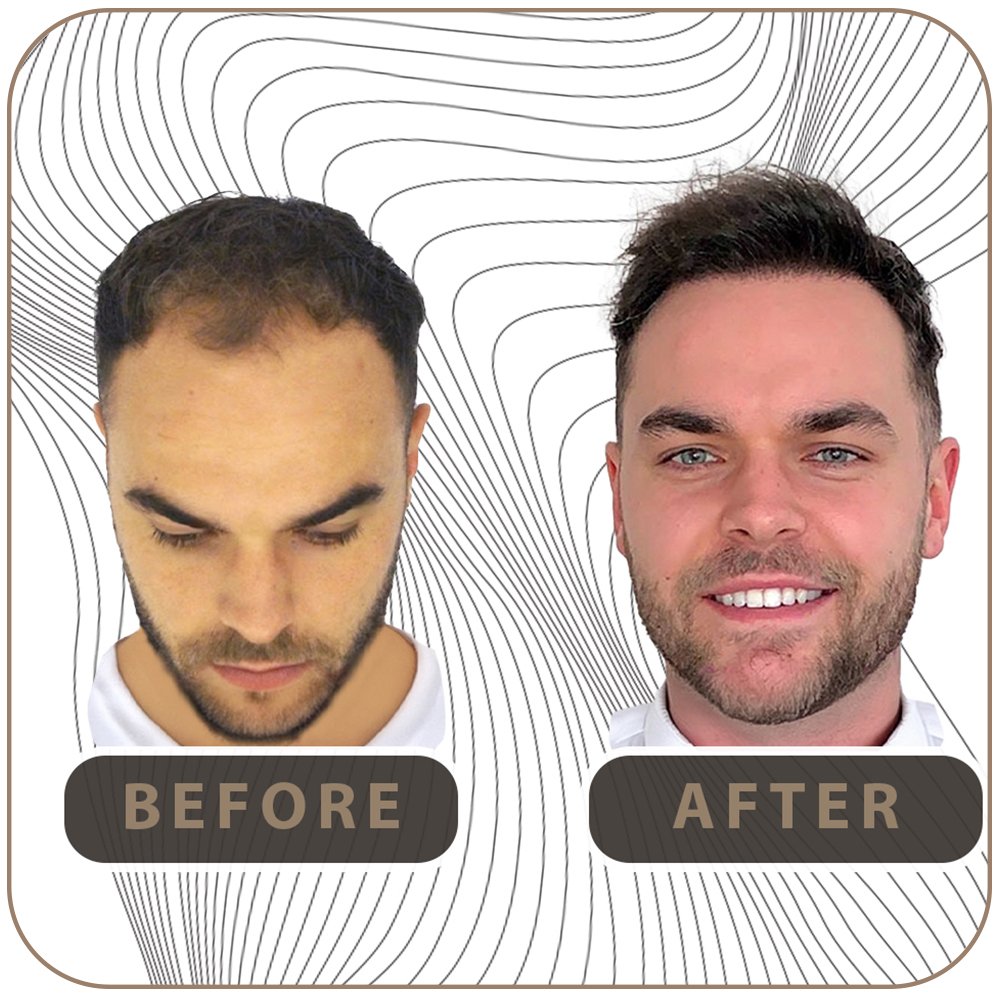 男性のM字ハゲ・生え際の後退を改善した自毛植毛のビフォーアフター症例写真