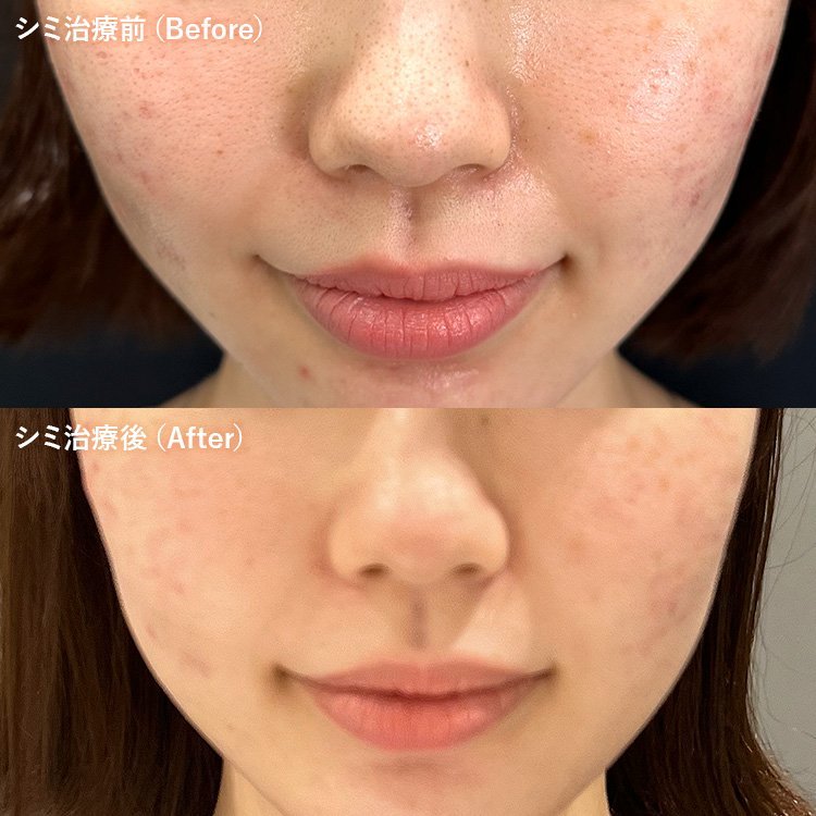 美容皮膚科でのシミ取り治療の症例写真。治療前の頬の細かいシミ（そばかす・老人性色素斑）と、治療後に肌がトーンアップしてシミが薄くなった状態の比較